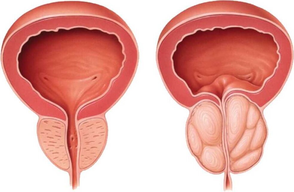 prostate sore throat